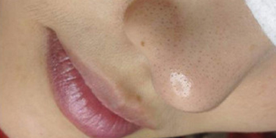 超微小氣泡術前