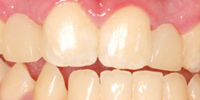 激光美白牙術(shù)前