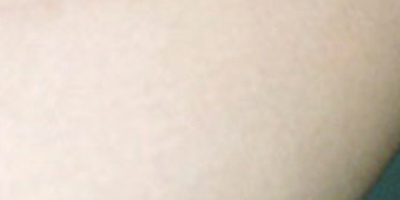 無(wú)創(chuàng)疤痕修復(fù)術(shù)后