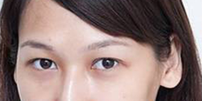 自體脂肪豐淚溝術后