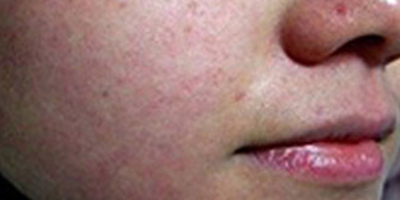 射頻美膚術(shù)前