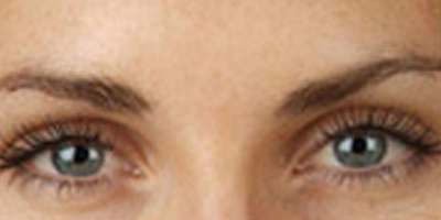 注射去川字紋術(shù)后