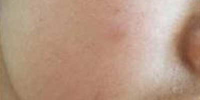 水光補(bǔ)水術(shù)前