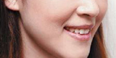 自體脂肪豐蘋果肌術后