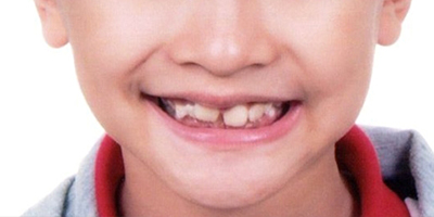 兒童早期干預(yù)矯治—mrc肌功能矯治術(shù)前