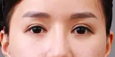 自體脂肪豐臥蠶術(shù)前