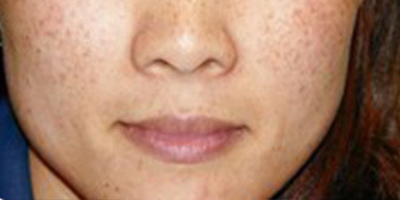 鐳射凈膚術(shù)前