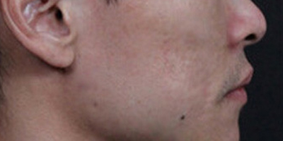 點(diǎn)陣激光術(shù)后