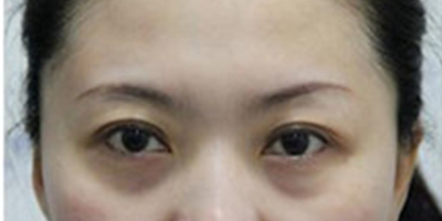 自體脂肪豐太陽(yáng)穴術(shù)后