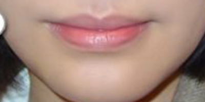 下巴膨體假體取出術(shù)后