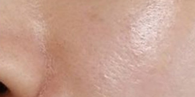 皮膚檢測術(shù)后