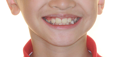 兒童早期干預(yù)矯治—mrc肌功能矯治術(shù)后