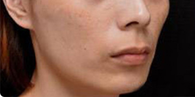 少女針術(shù)前