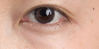 OPT美膚術(shù)后