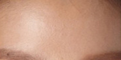 自體脂肪豐額頭術(shù)后