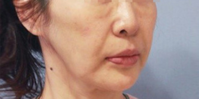 熱瑪吉術(shù)前