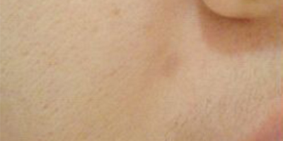 DPL美膚術(shù)前