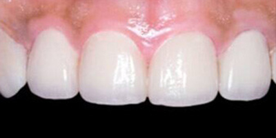 瓷貼面術(shù)后