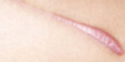 無(wú)創(chuàng)疤痕修復(fù)術(shù)前