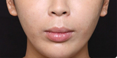 注射頦肌放松術后