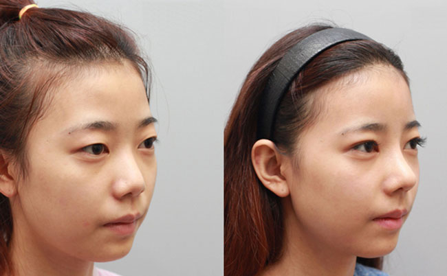 耳軟骨隆鼻的優(yōu)缺點(diǎn)是什么？肋軟骨隆鼻和耳軟骨隆鼻有什么區(qū)別？