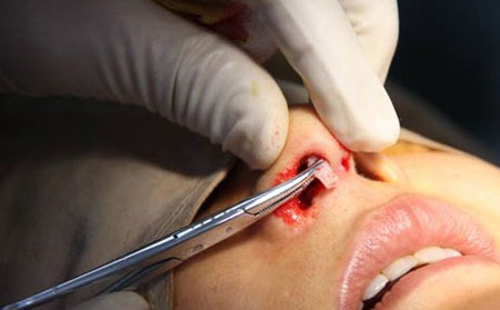 鼻子假體取出需要多少錢？取出后鼻子會(huì)恢復(fù)原來樣子嗎？