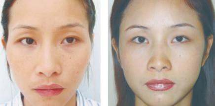 假體填充豐太陽穴怎么做？假體豐太陽穴的方法有哪些？