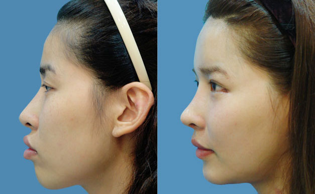 上下顎矯正術(shù)是什么手術(shù)啊？下頜角骨骼大用什么方法去除？