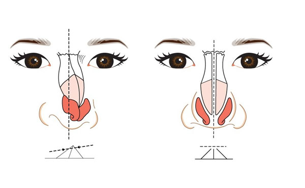 歪鼻矯正術(shù)的風(fēng)險大嗎?鼻梁歪怎么矯正歪鼻的矯正及補救方法?