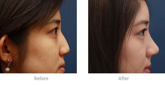 隆鼻假體取出后鼻子會不會變形？隆鼻假體取出后能不能恢復(fù)原樣？