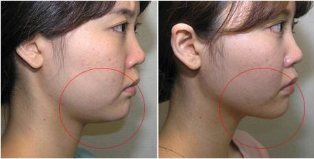 雙下巴吸脂多長時(shí)間恢復(fù)？雙下巴吸脂術(shù)能保持多久？