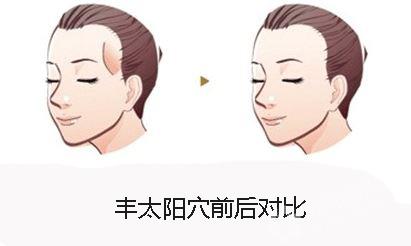 什么是自體脂肪豐太陽穴？用自體脂肪豐太陽穴的效果能維持多久？