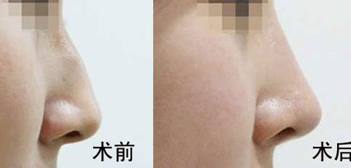 駝峰鼻矯正的方法有哪些？駝峰鼻矯正的方式及適合人群？