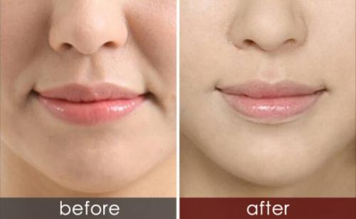 玻尿酸祛除法令紋的優(yōu)勢？玻尿酸和肉毒素祛法令紋，哪一種效果好？