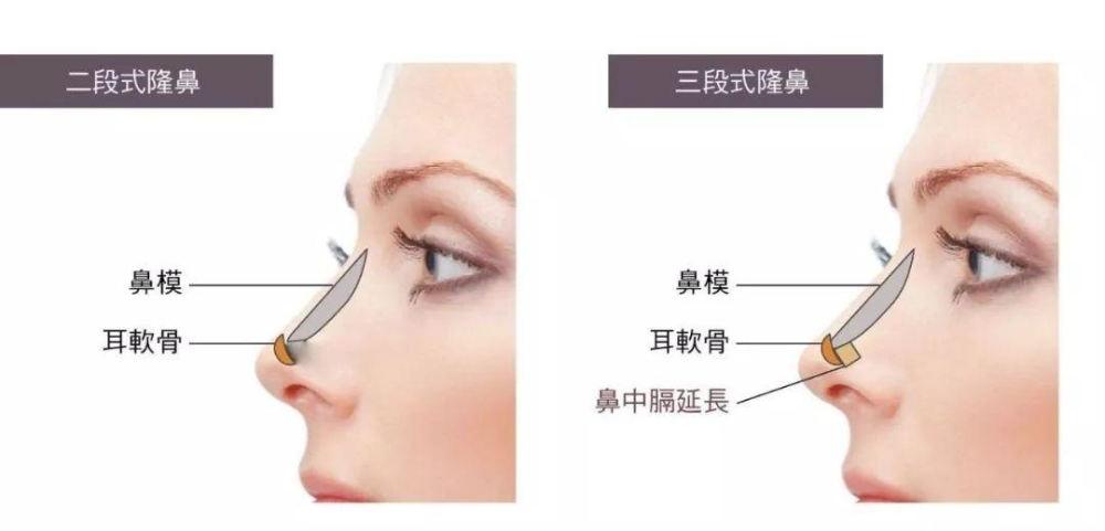 自體軟骨隆鼻的手術(shù)優(yōu)缺點有哪些？肋軟骨填充鼻基底多久能自然？