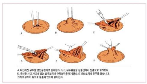 乳頭內(nèi)陷矯正手術(shù)多少錢？乳頭內(nèi)陷矯正手術(shù)多久可以恢復(fù)？