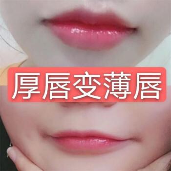 厚唇改薄整形手術(shù)價(jià)格？厚唇改薄多久完全恢復(fù)？