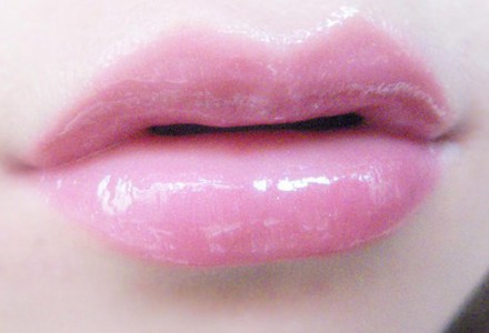 自體脂肪豐唇效果好嗎？自體脂肪豐唇大概多少錢(qián)？