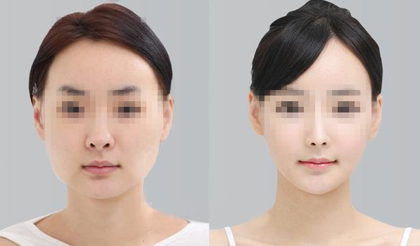 做下頜角整形手術(shù)效果好嗎？下頜角整形手術(shù)要多少錢？