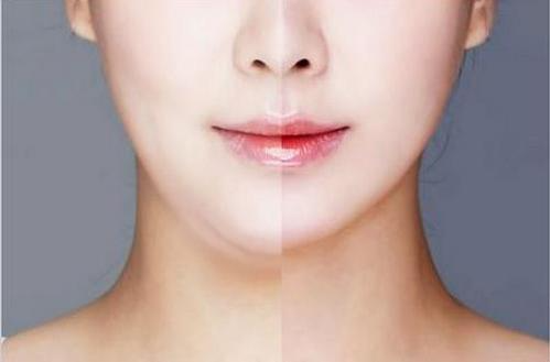 面部吸脂最好的辦法是什么？做一次面部吸脂多少錢？