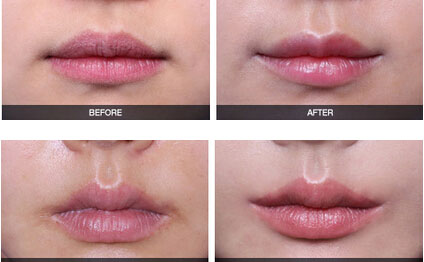 嘴角上揚術(shù)有幾種方法？嘴角上揚術(shù)疤痕恢復(fù)期？