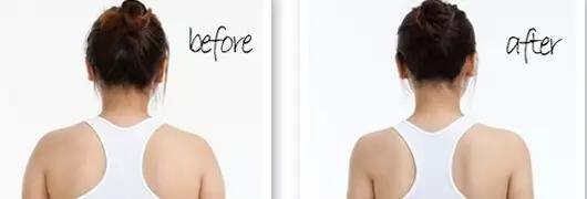 后背抽脂那些人可以做？吸脂瘦肩膀多少錢？