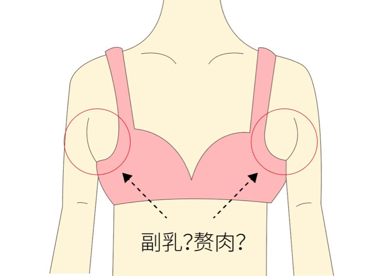 手術(shù)去副乳效果怎么樣？手術(shù)去副乳要注意什么？