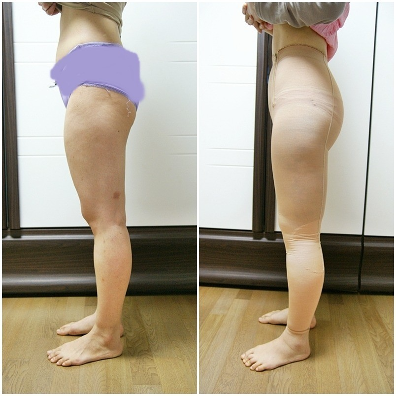 吸脂瘦大腿腫脹期是多久？大腿吸脂有什么后遺癥嗎？