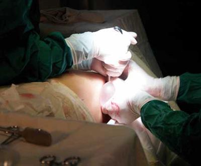 胸部假體取出多久可以重新做 ？胸部假體取出注意事項(xiàng)？