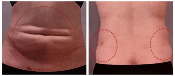 吸脂失敗了多久可以修復(fù)？吸脂失敗修復(fù)怎么解決？