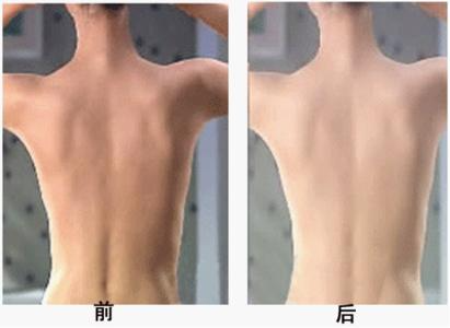 背部吸脂多久恢復(fù)？吸脂瘦背部注意事項(xiàng)