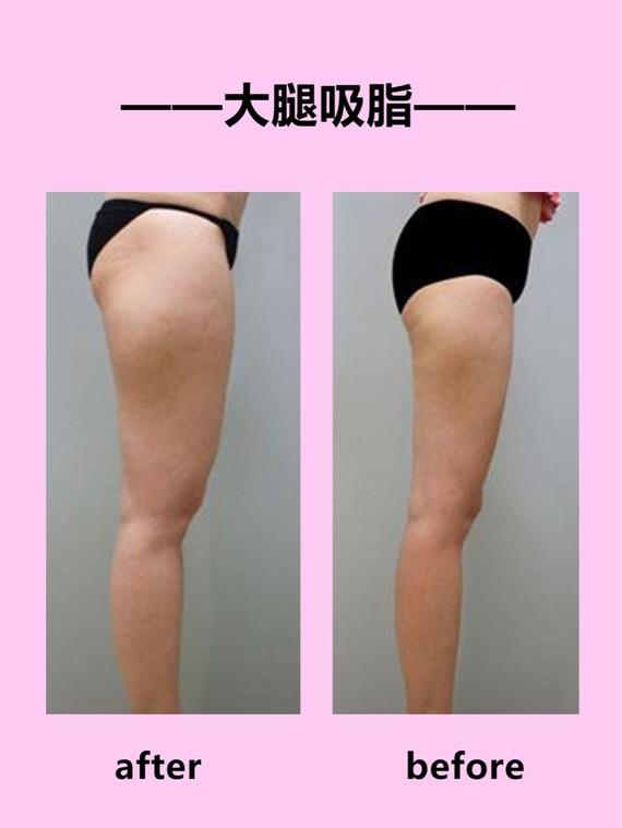 吸脂瘦大腿腫脹期是多久？大腿吸脂有什么后遺癥嗎？