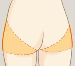  射頻溶脂瘦臀部的優(yōu)缺點 射頻溶脂有哪些功效