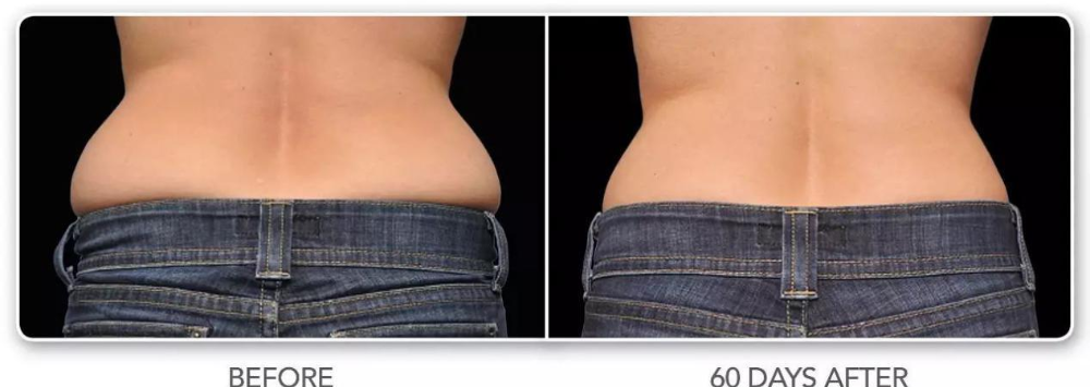 冷凍溶脂瘦臀部的效果怎么樣  冷凍溶脂瘦臀部需要注意什么